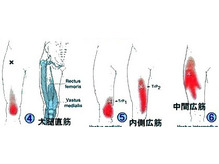 内転筋トリガーポイント
